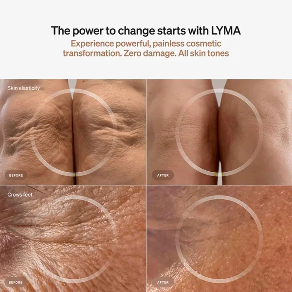 LYMA Laser Starter Kit Bundle