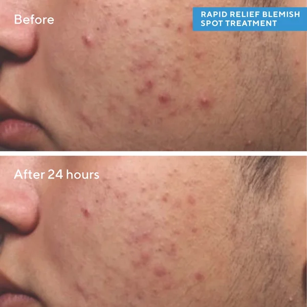 Murad Rapid Relief Spot Treatment 15ml