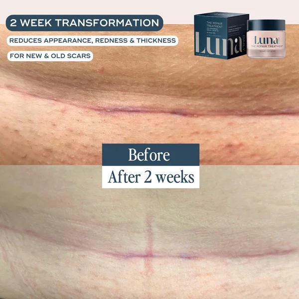 Luna Daily The Skin Repair Treatment For Scars And Hyperpigmentation 50ml