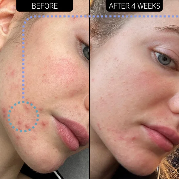 The INKEY List Blemish Clearing Moisturizer 2% NovoRetin 50ml