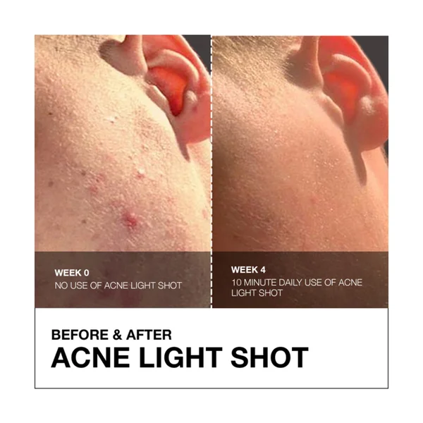 FaceGym Acne Light Shot Device