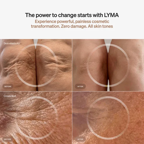 LYMA Laser Starter Kit