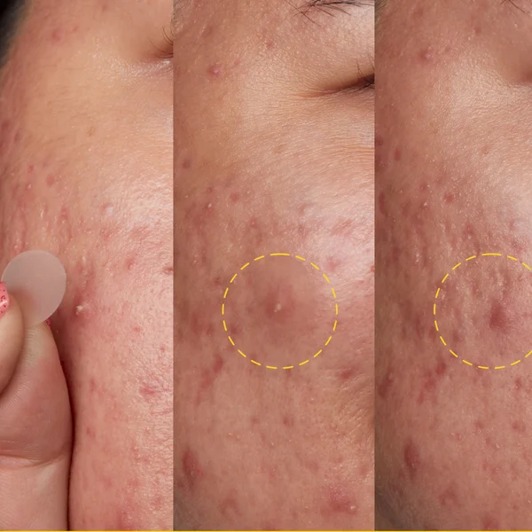 Peace Out Acne Day Dot - Normal