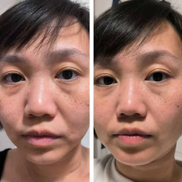 Qure Micro-Infusion Targeted Patches (8 Pairs)