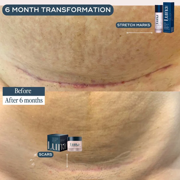 Luna Daily The Skin Repair Treatment For Scars And Hyperpigmentation 50ml