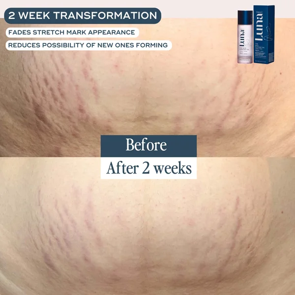 Luna Daily The Skin Support Oil For Stretch Marks And Hyperpigmentation 100ml