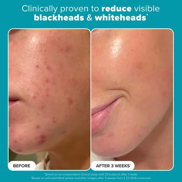 Paula's Choice Skin Perfecting 2% BHA Liquid Exfoliant - Trial Size (30ml)